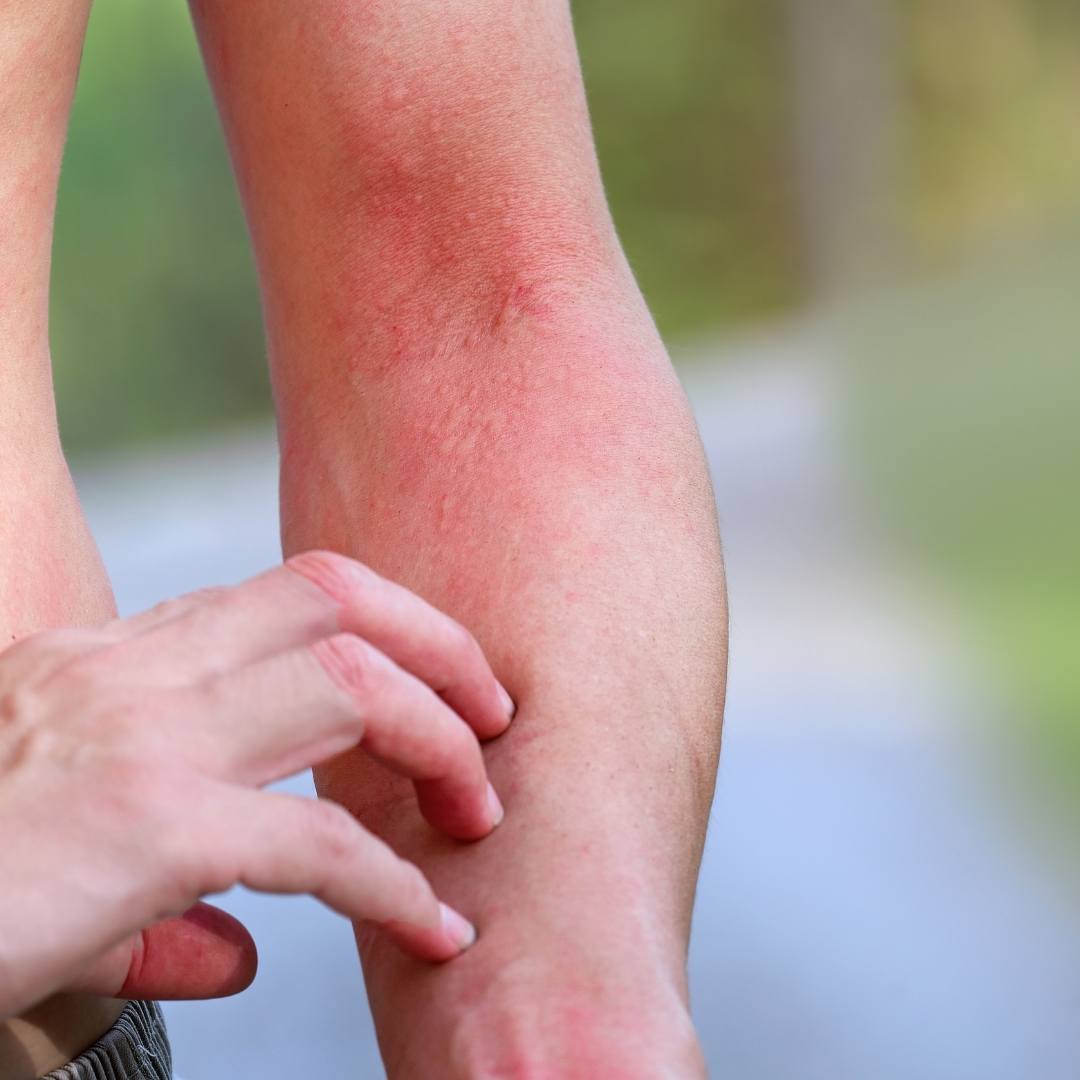 A Guide To Common Summer Rashes Forefront Dermatology