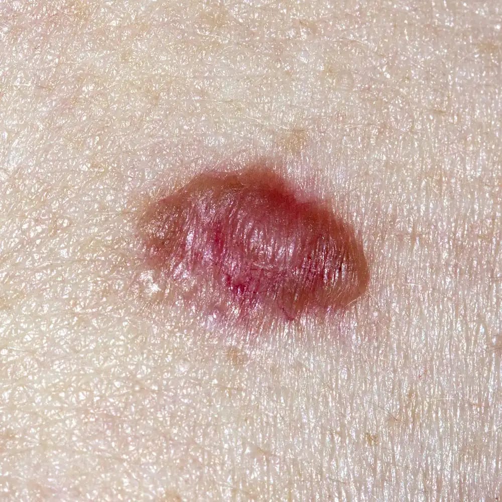 basal-cell-carcinoma-treatment-1000x1000
