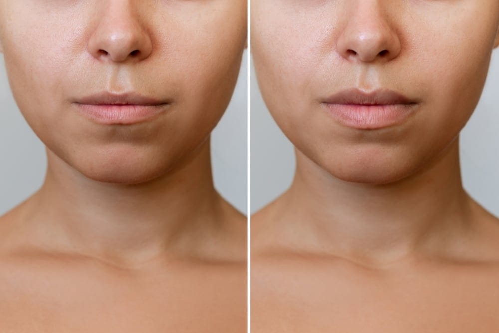Result of lip augmentation young woman's lower part of face with lips before and after lip enhancement