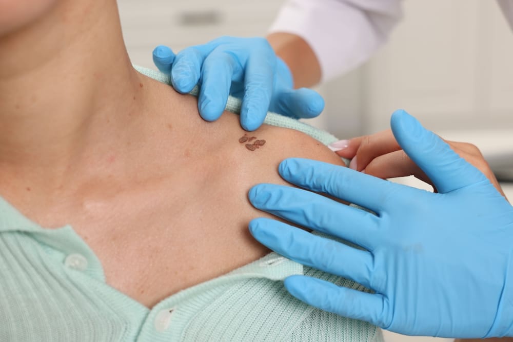 Doctor examining young woman's mole in hospital, closeup, before ordering skin biopsy