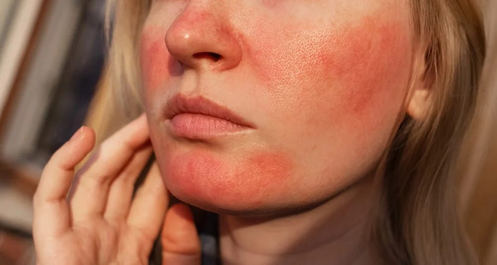 Rosacea and couperosis of the skin. The girl suffers from redness on her cheeks or sunburn symptoms. Redness and capillary mesh are visible on the face. Vascular surgery and dermatol