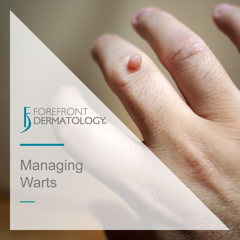 managing warts