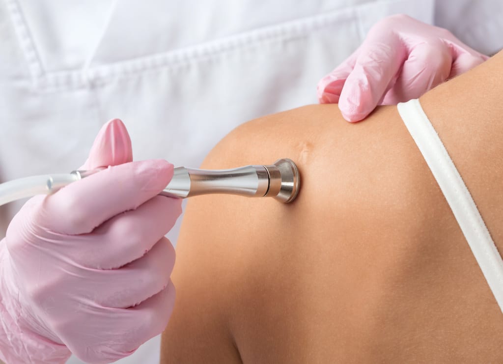 microderm abrasion on scar on shoulder