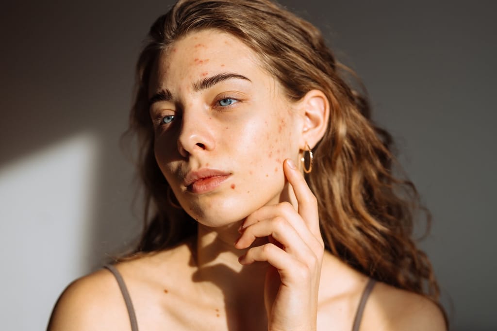 woman inspecting acne scars on face