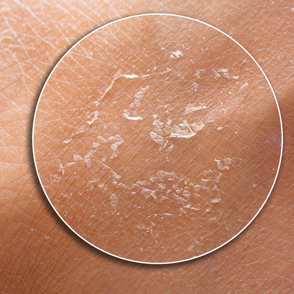 Macro shot of dry human skin flaking and peeling on the surface