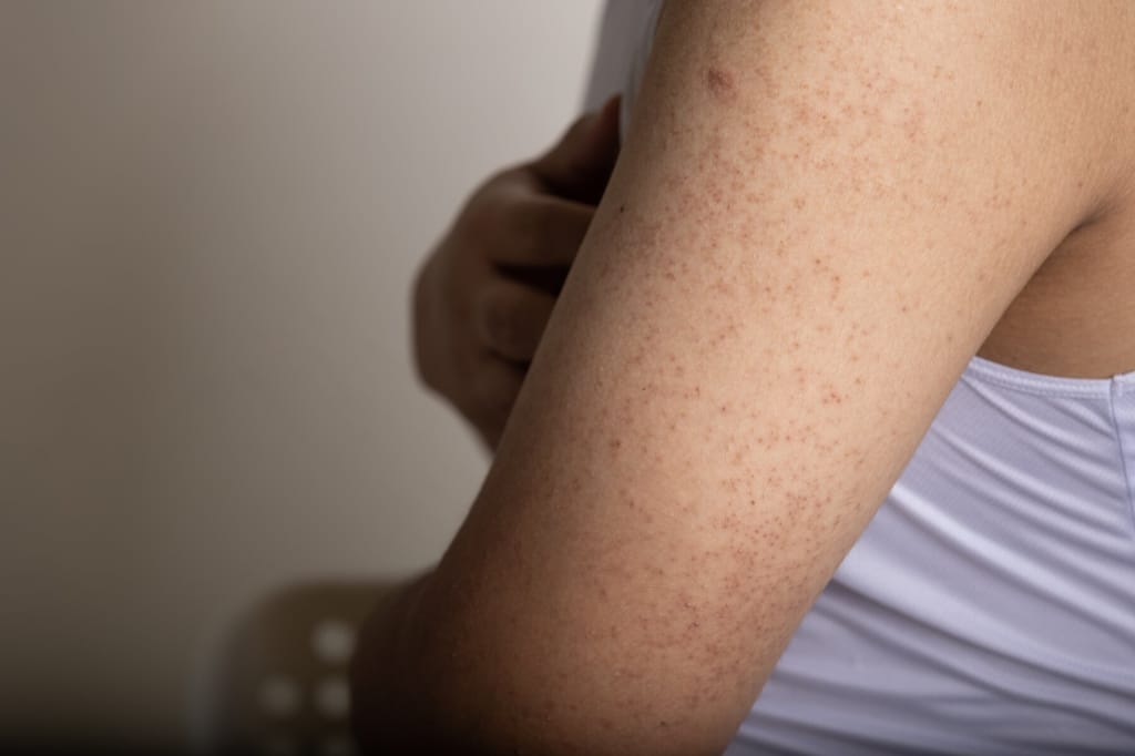 Keratosis Pilaris a harmless skin condition that causes dry, rough patches and tiny bumps, often on the upper arms