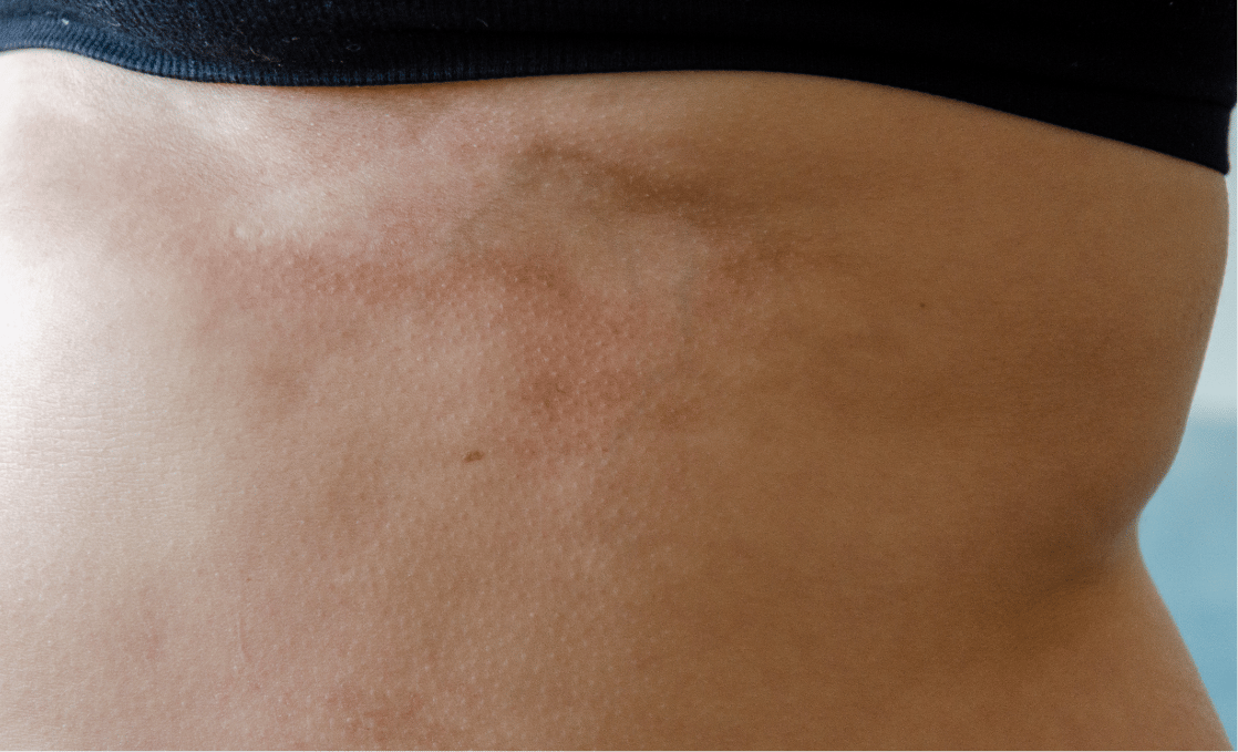 what causes scleroderma