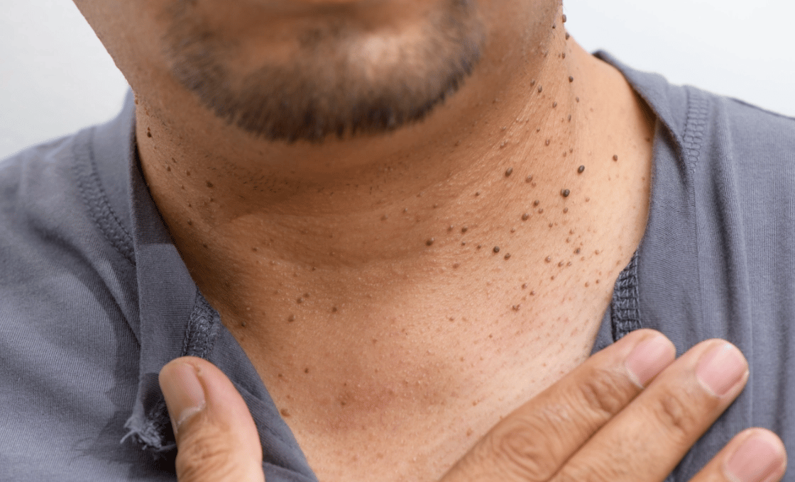 skin tag treatment