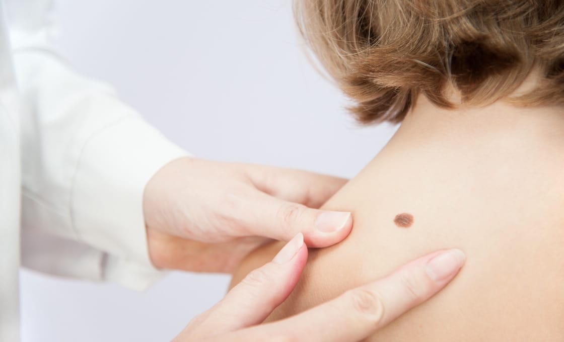 Melanoma Treatment Options
