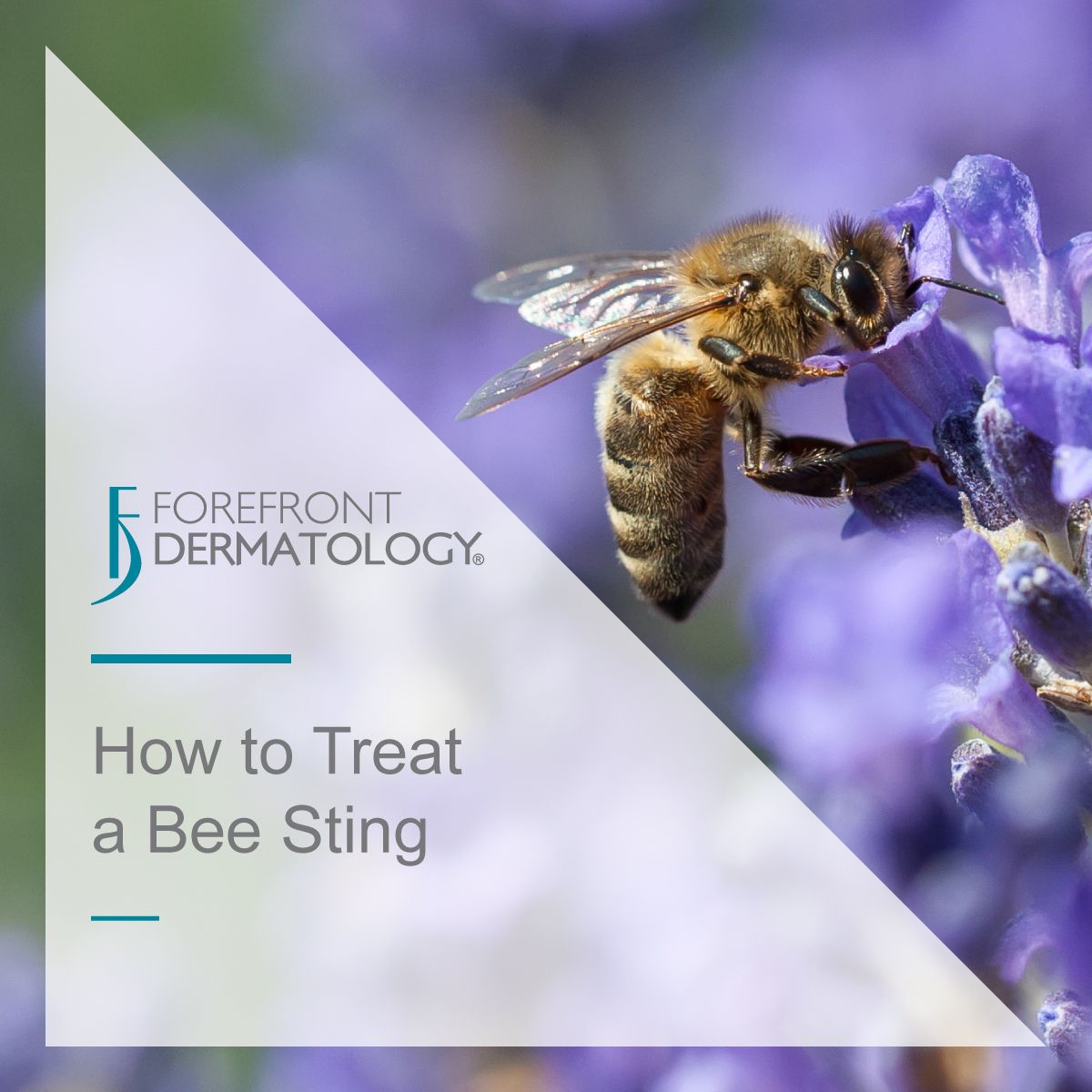 how to treat a bee sting