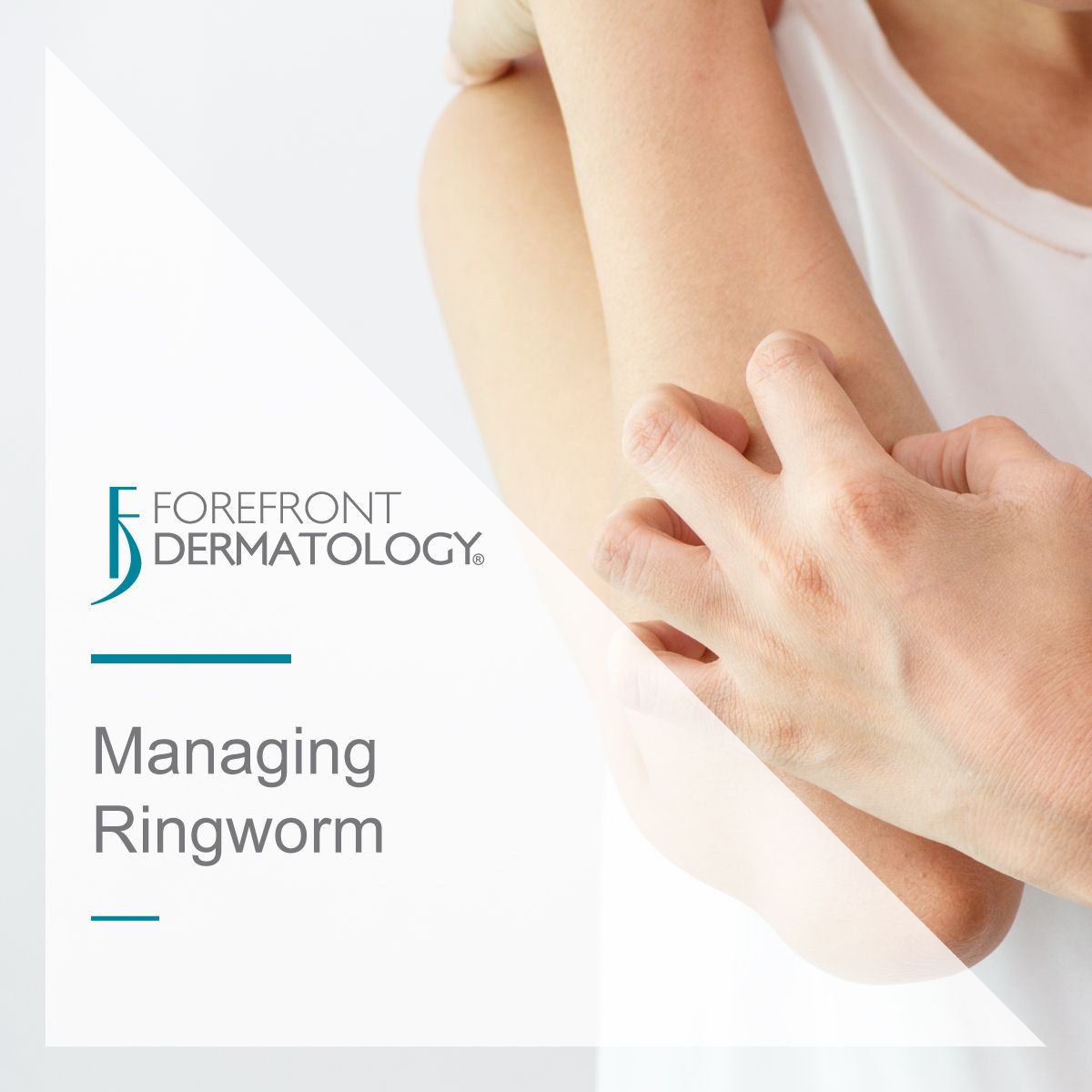 managing ringworm