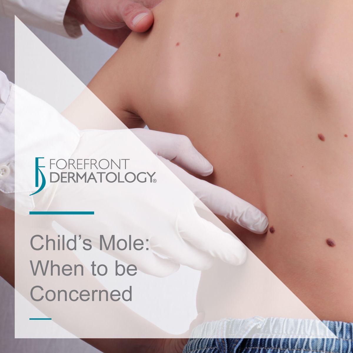 child moles