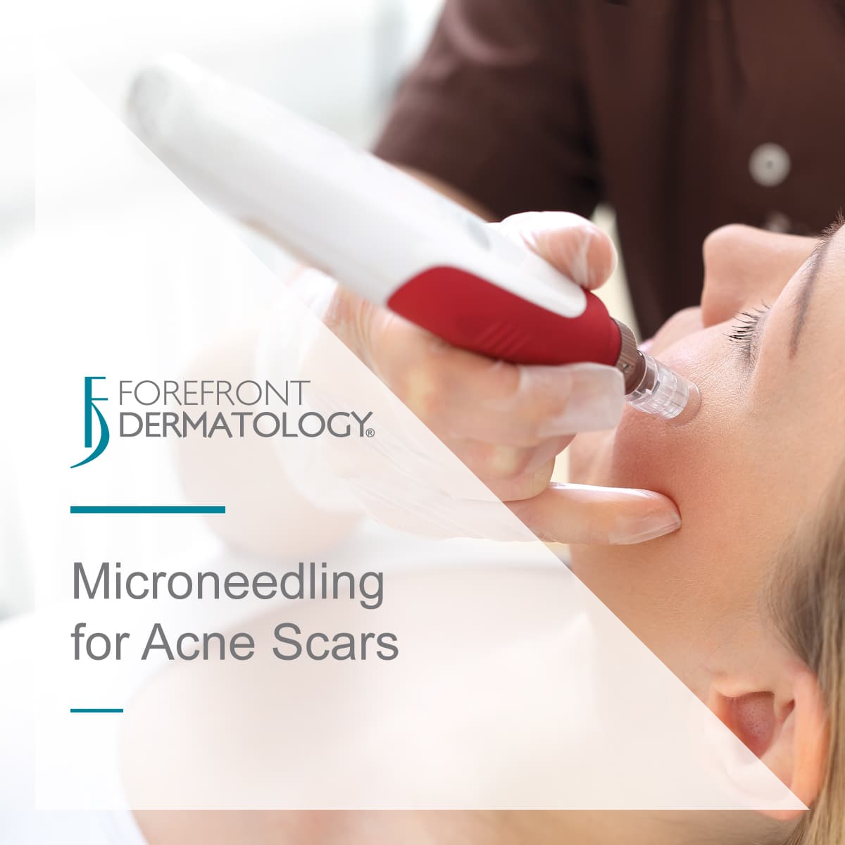 microneedling for acne scars