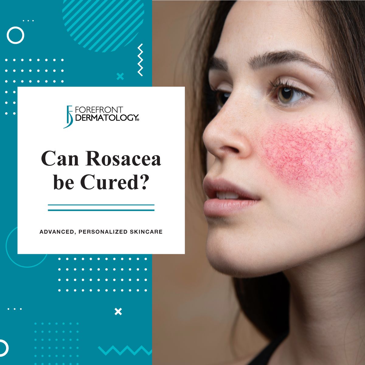 Rosacea