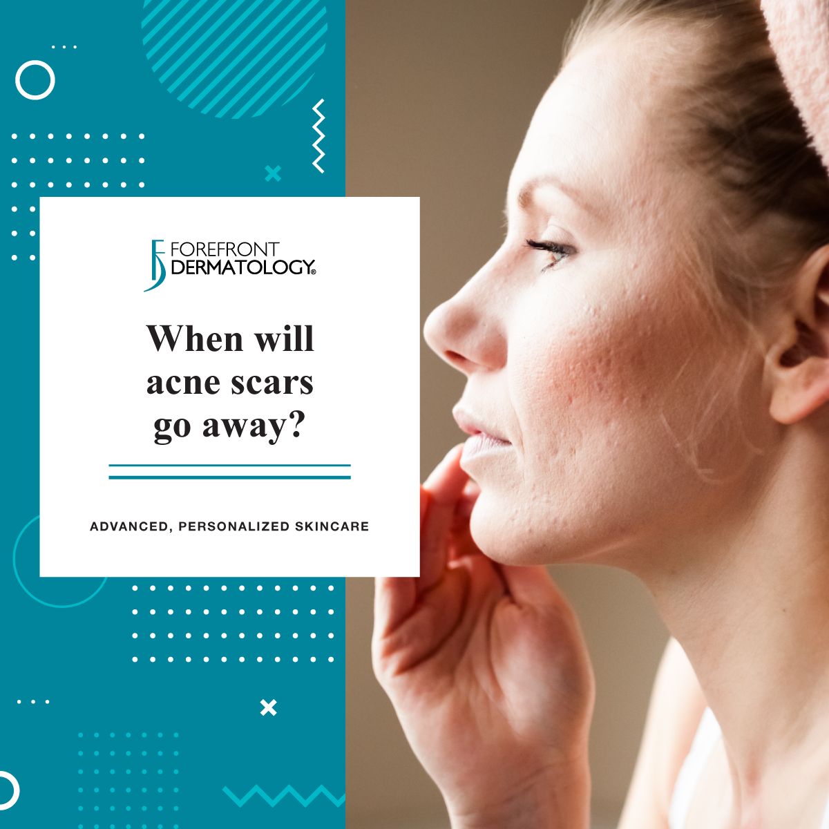 when will acne scars go away
