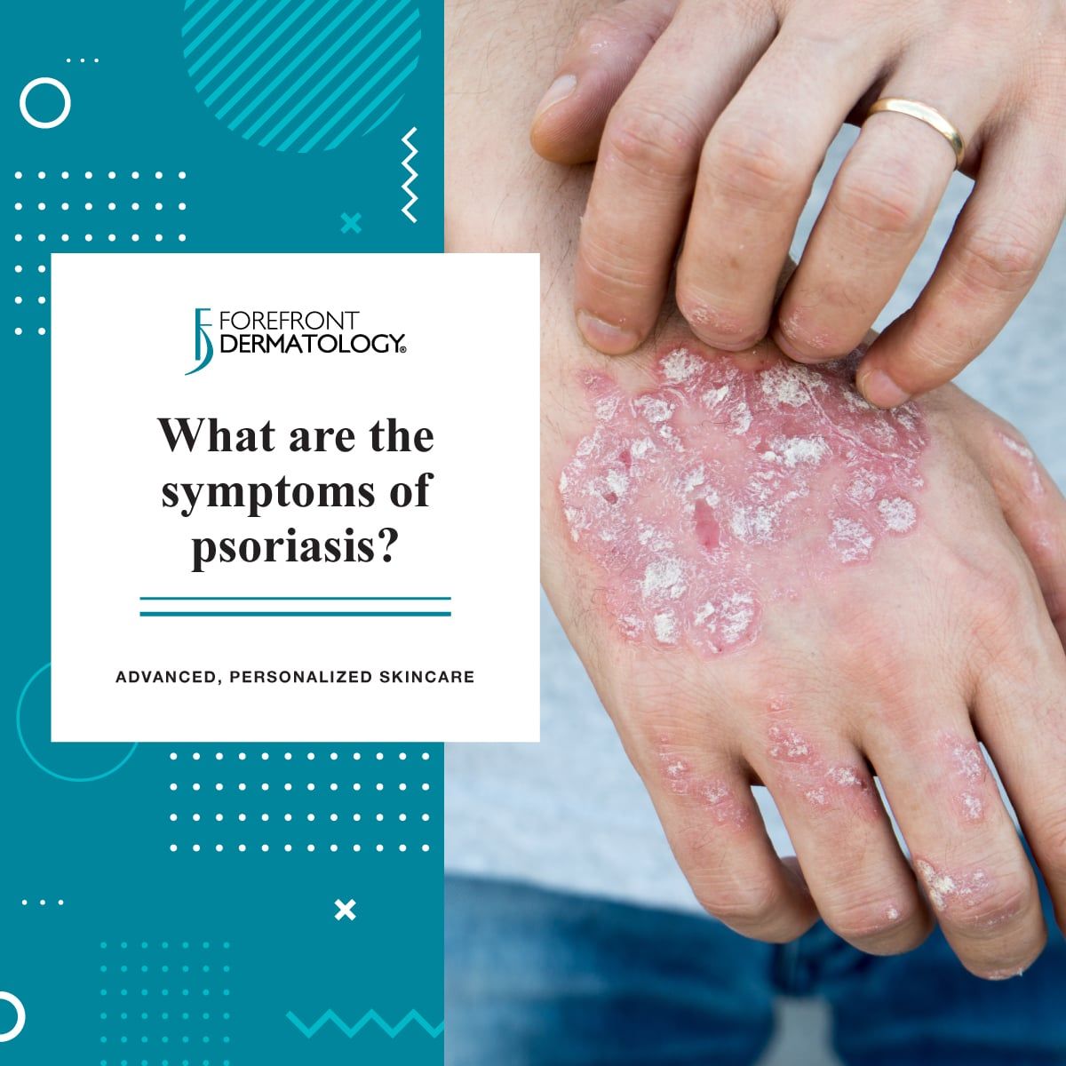 Psoriasis symptoms
