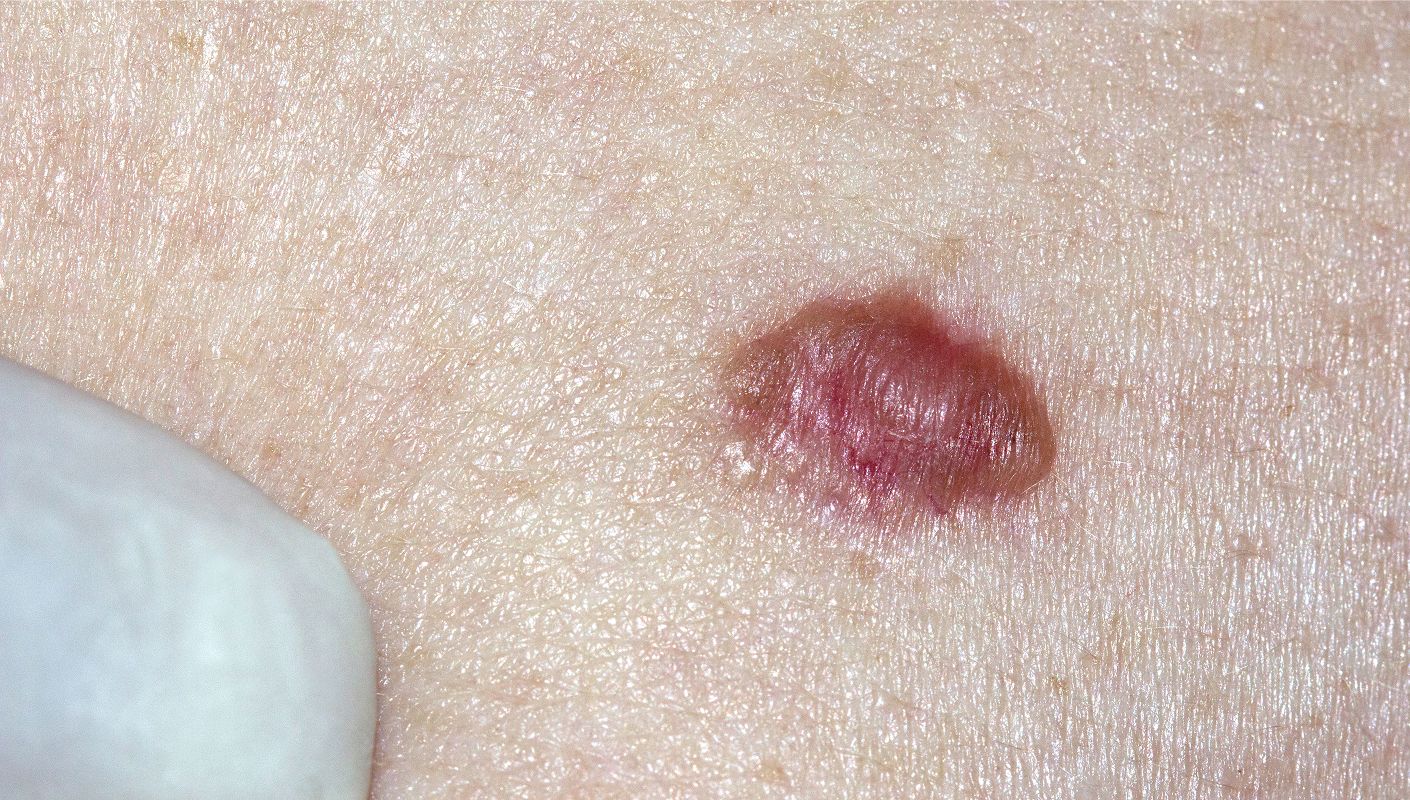 Acne treatment consultation