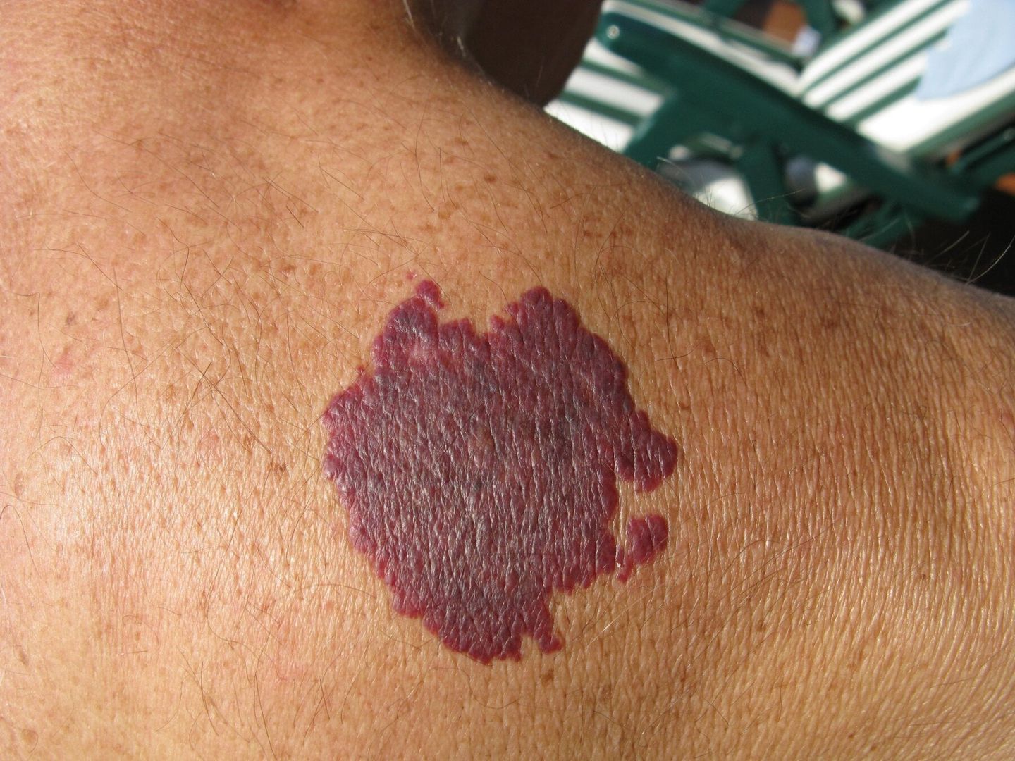 When to Consider Birthmark Removal