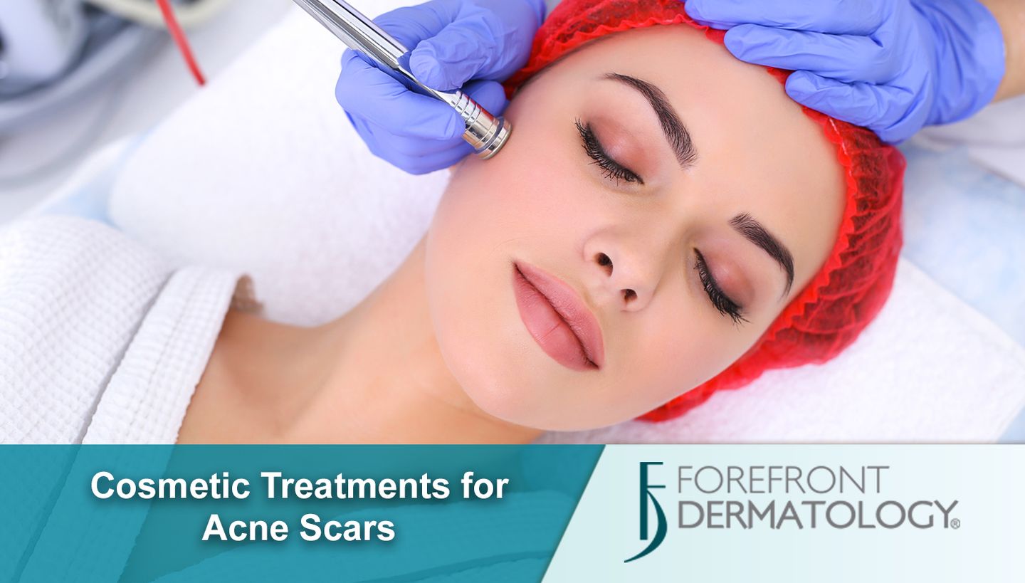 acne scars