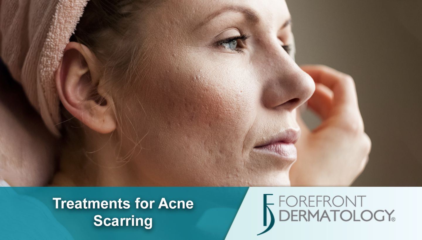 ACNE SCARRING