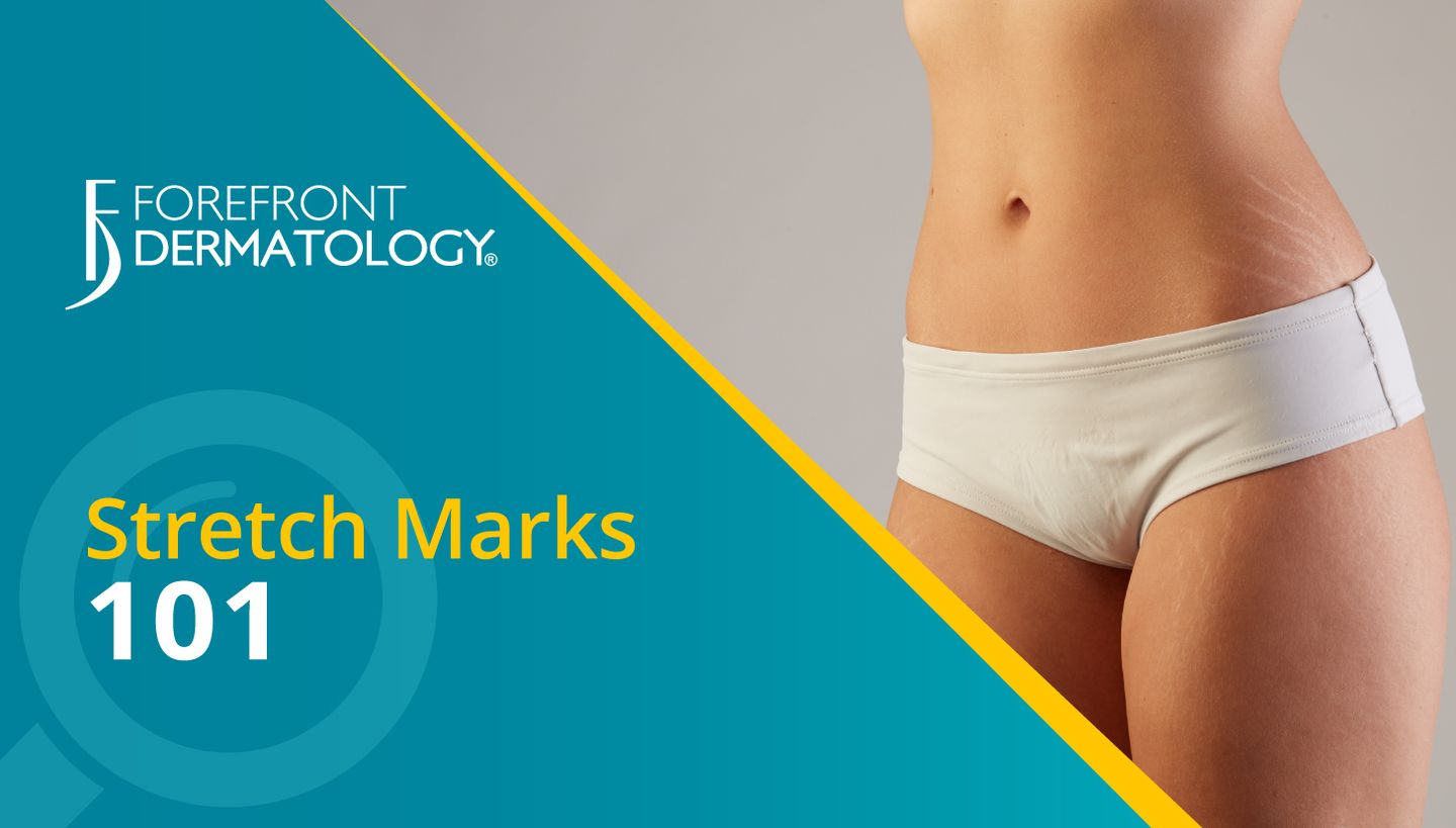 STRETCH MARKS 101