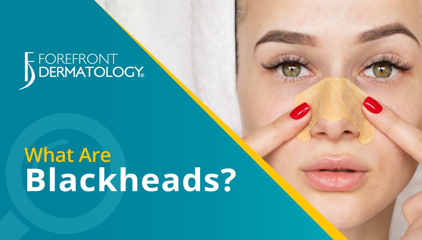 What are Blackheads