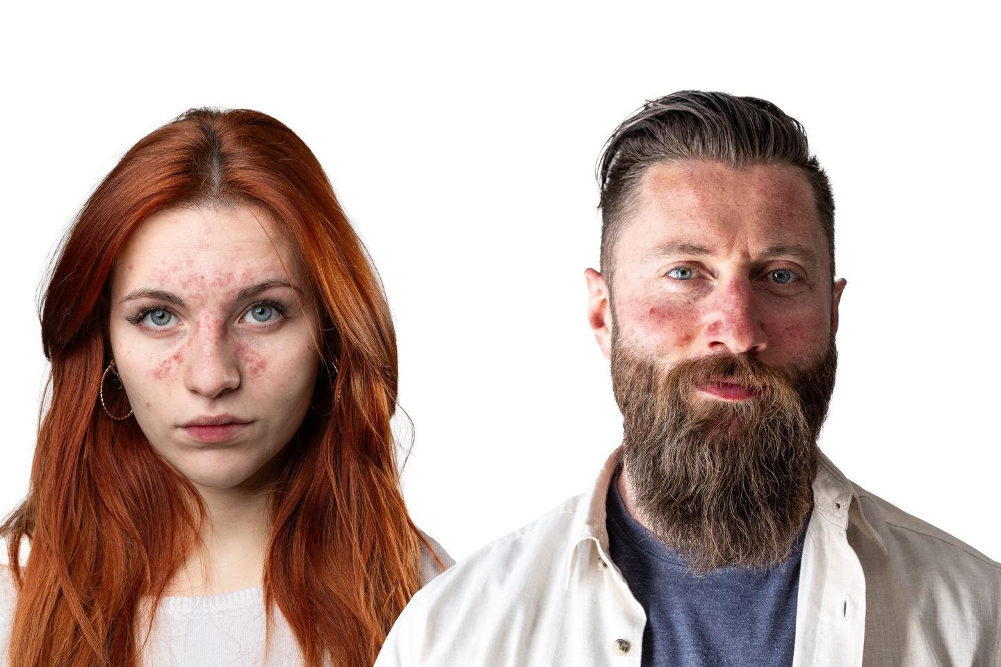 man and woman both suffering from rosacea on skin face