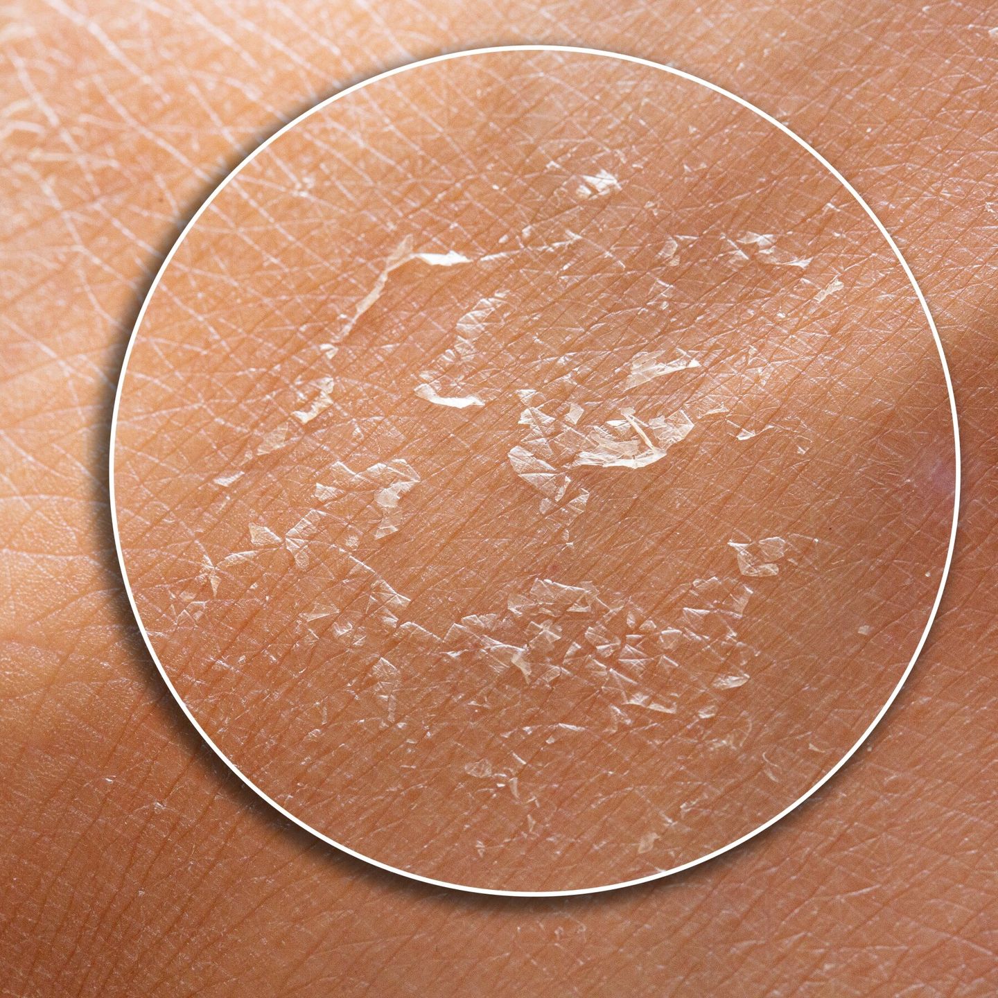 Macro shot of dry human skin flaking and peeling on the surface