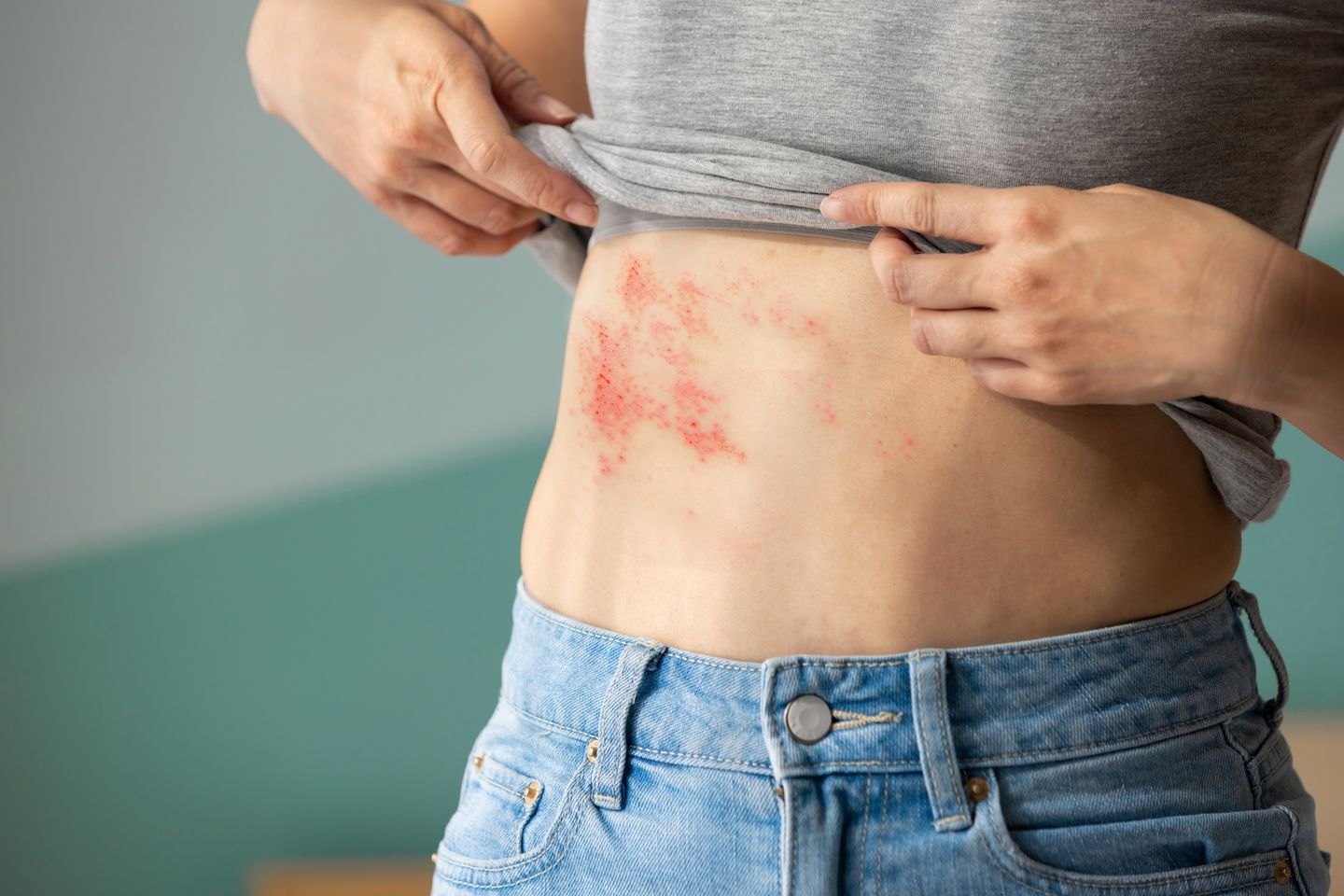 Woman with shingles on the skin she feels very painful