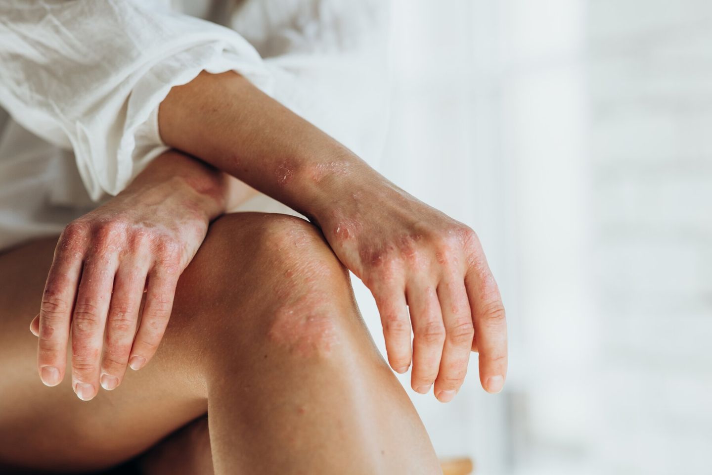Exploring My Psoriasis Treatment Options
