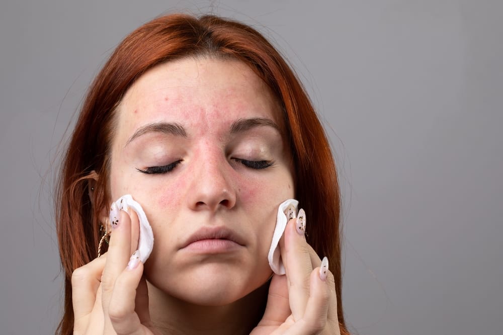 Caucasian girl  with facial redness due to allergy contained in cosmetic products irritation