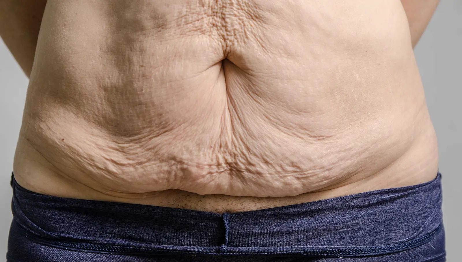 treatments for chest sagging post-glp-1 Ozempic Breasts: What to Know About This Weight Loss Drug Side Effect All the Ways to Firm