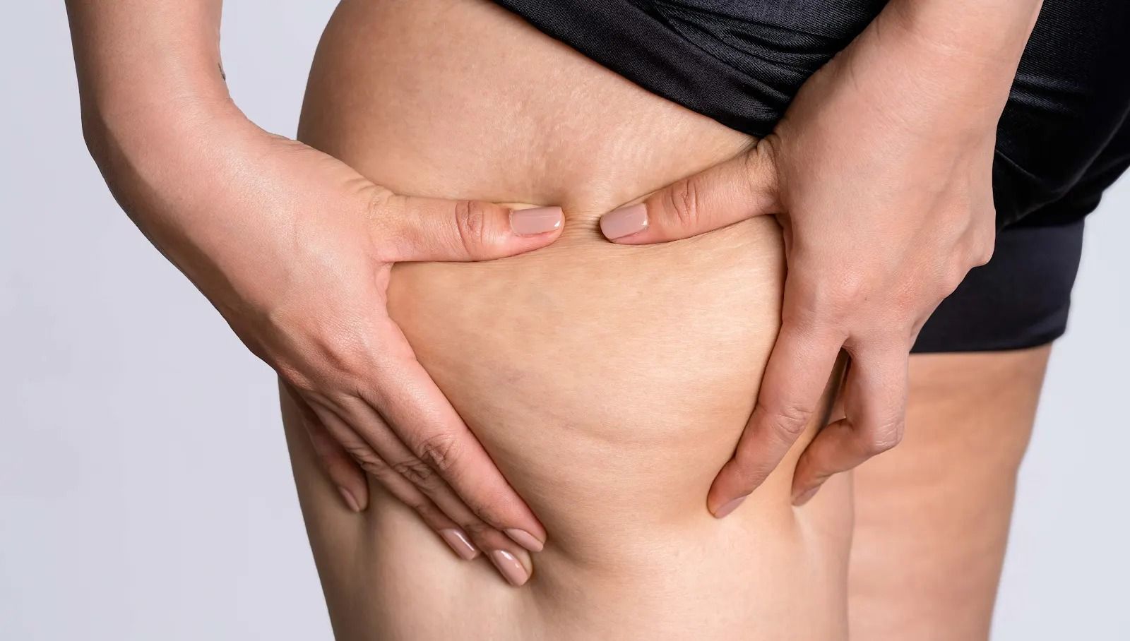 Thigh lift