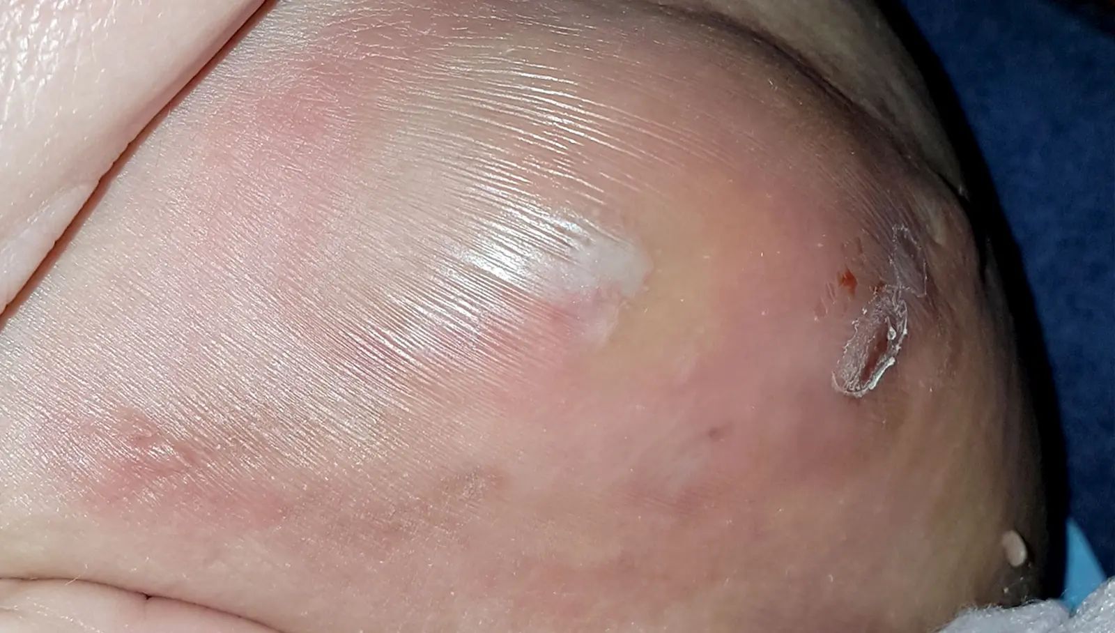 Hidradenitis Suppurativa