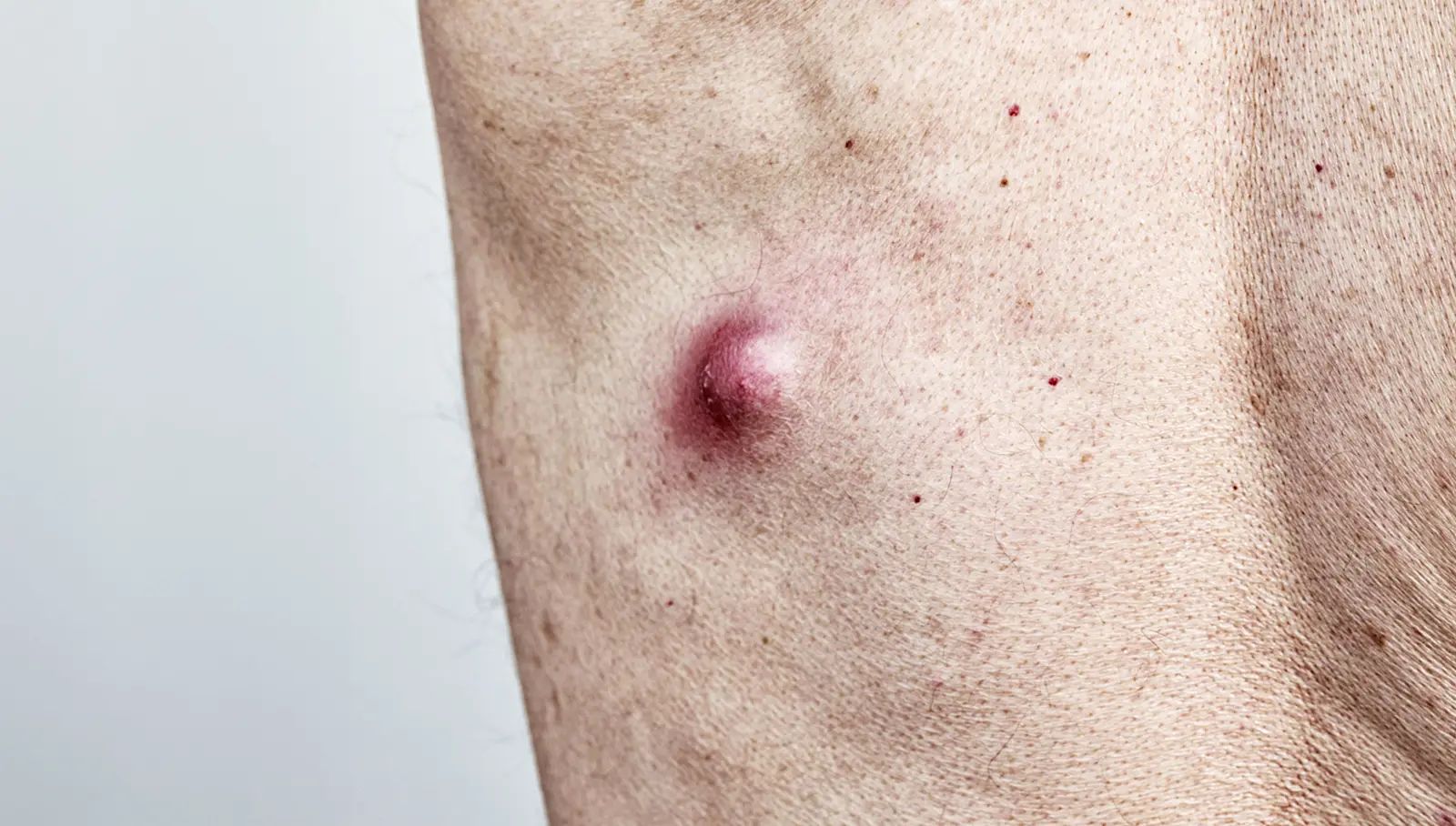 Cysts