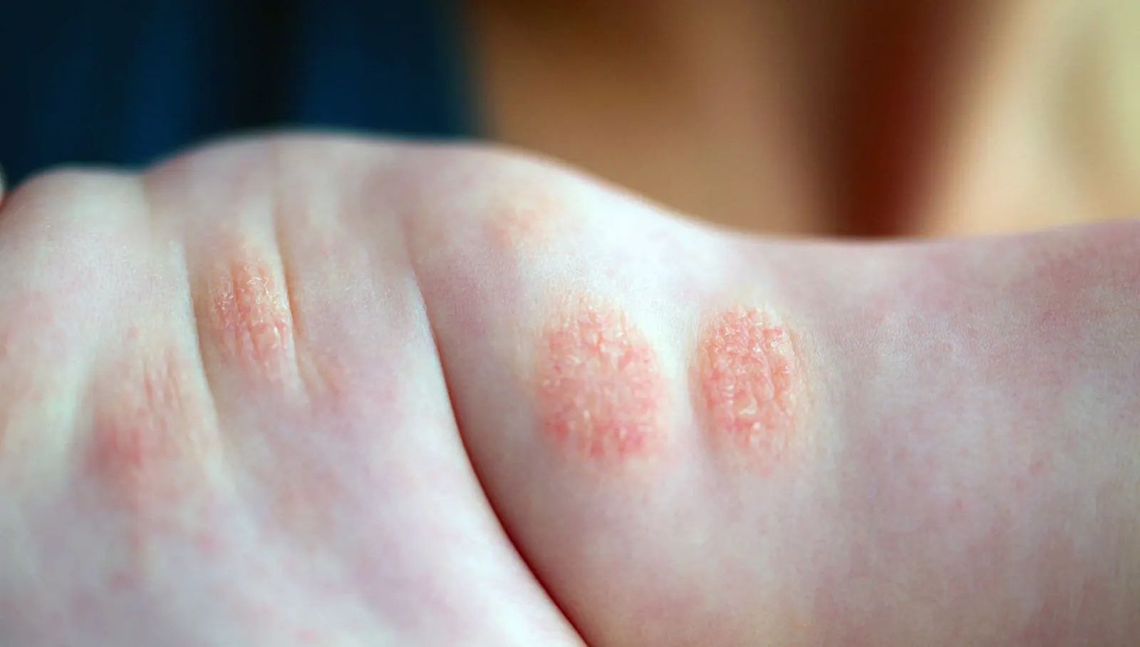 Nummular Dermatitis