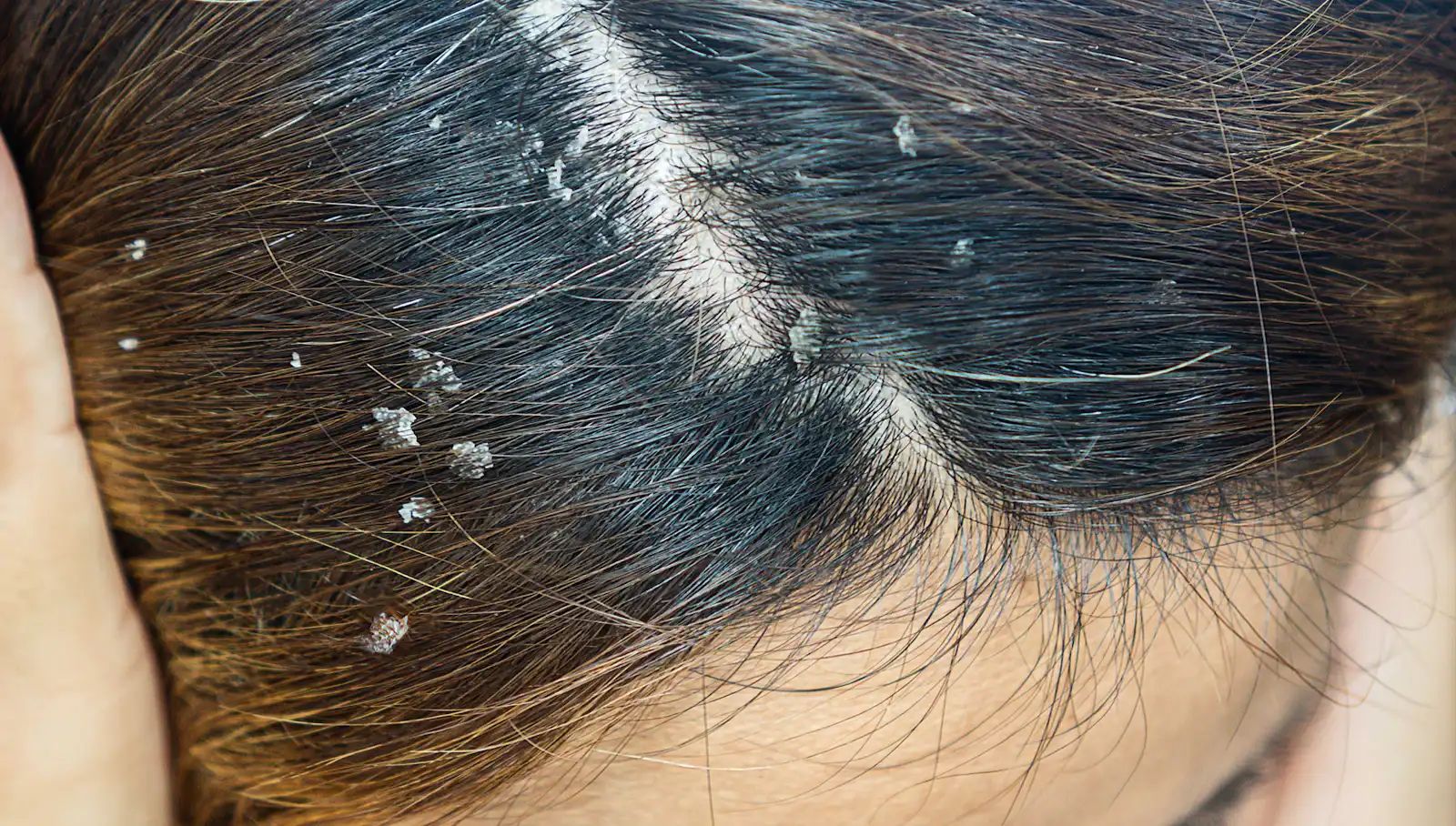 Seborrheic Dermatitis
