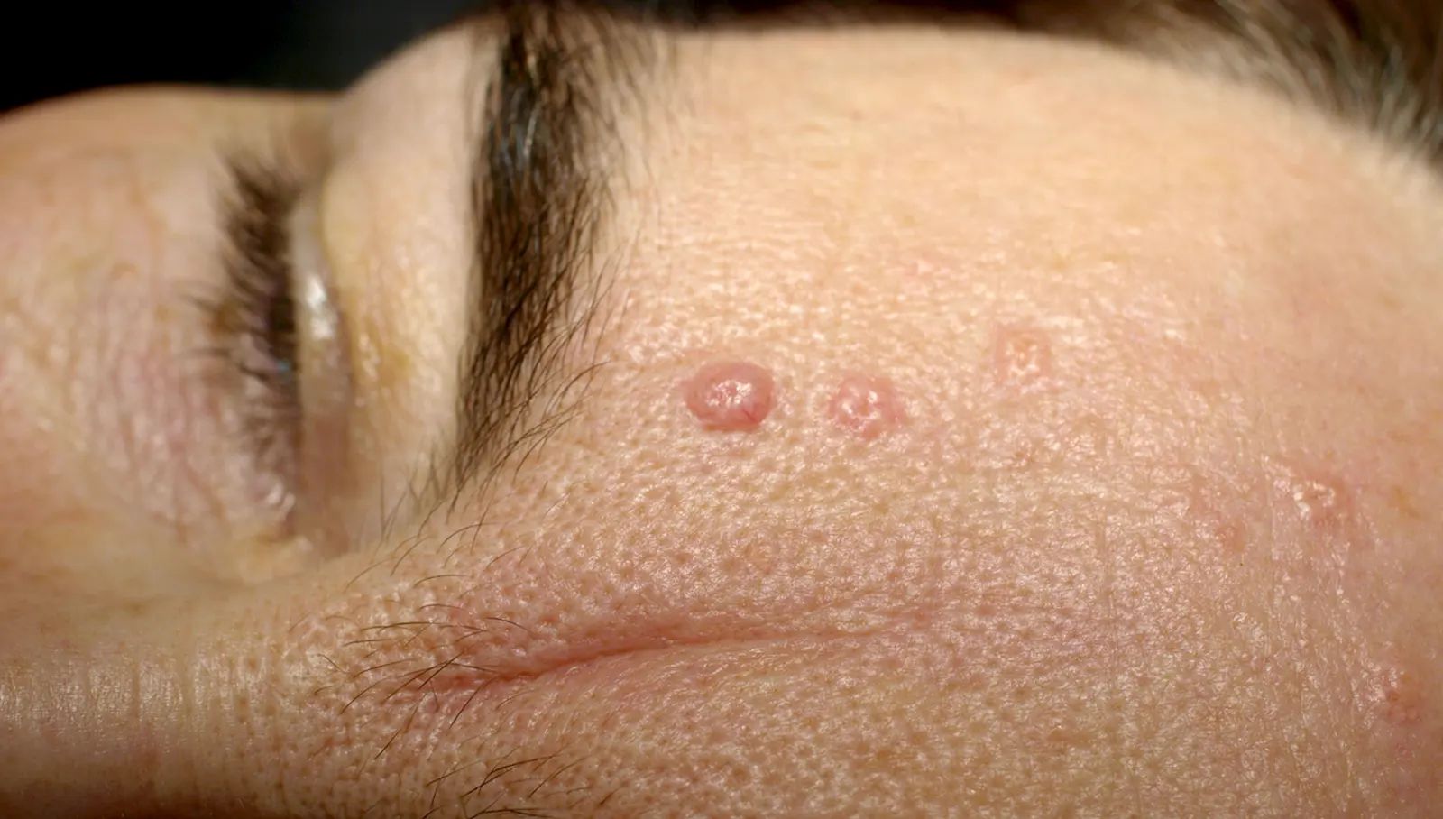 Sebaceous Hyperplasia