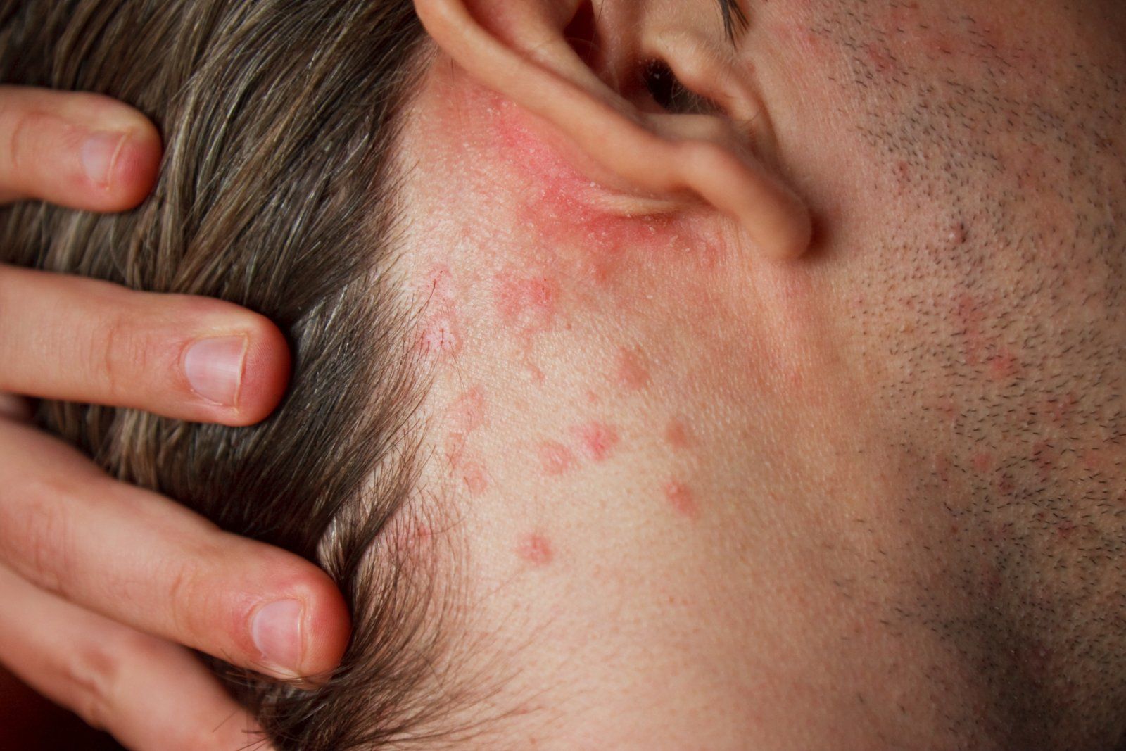 Close-up of a skin condition being examined