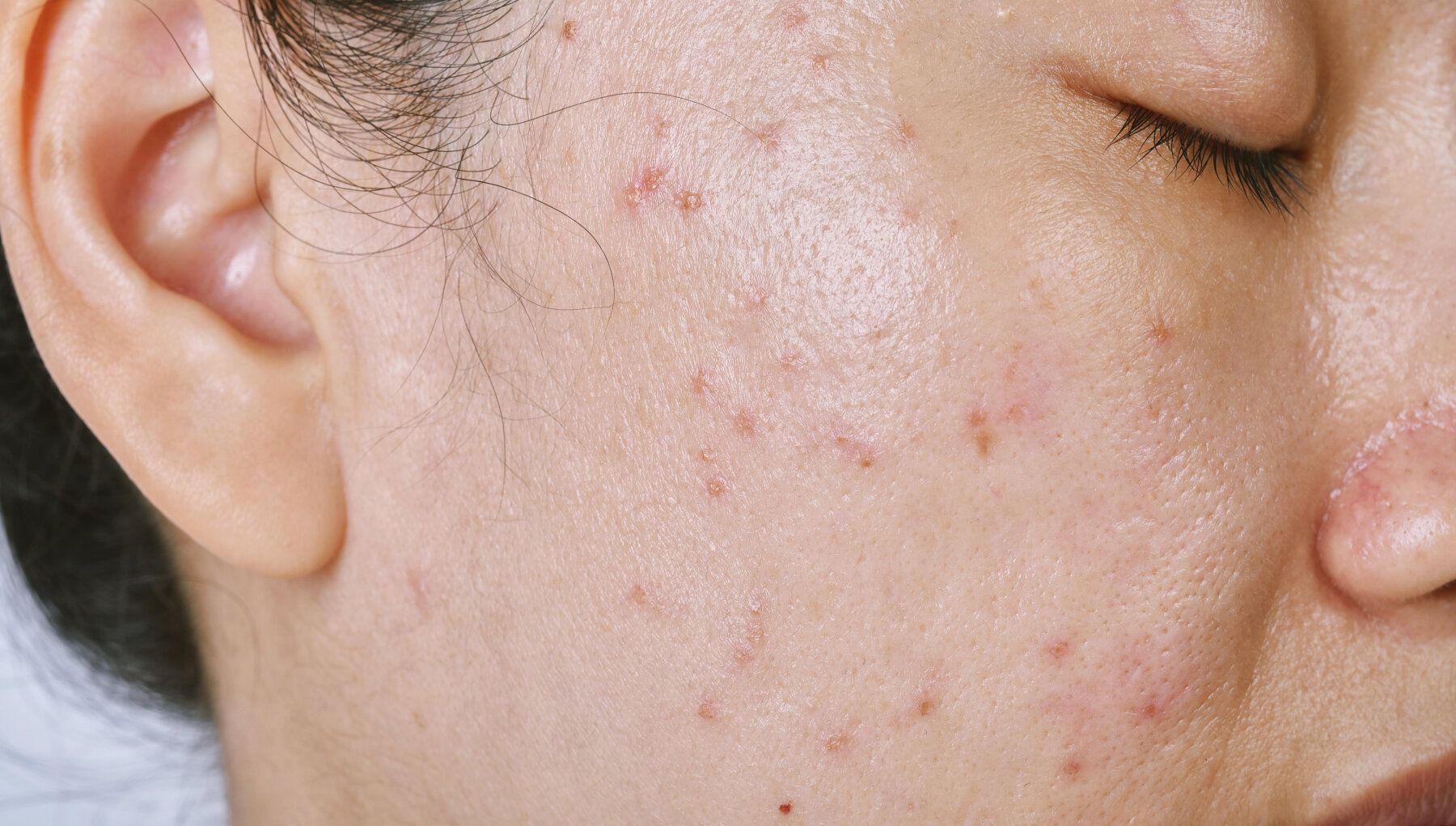 Cutera® Laser Genesis for Acne