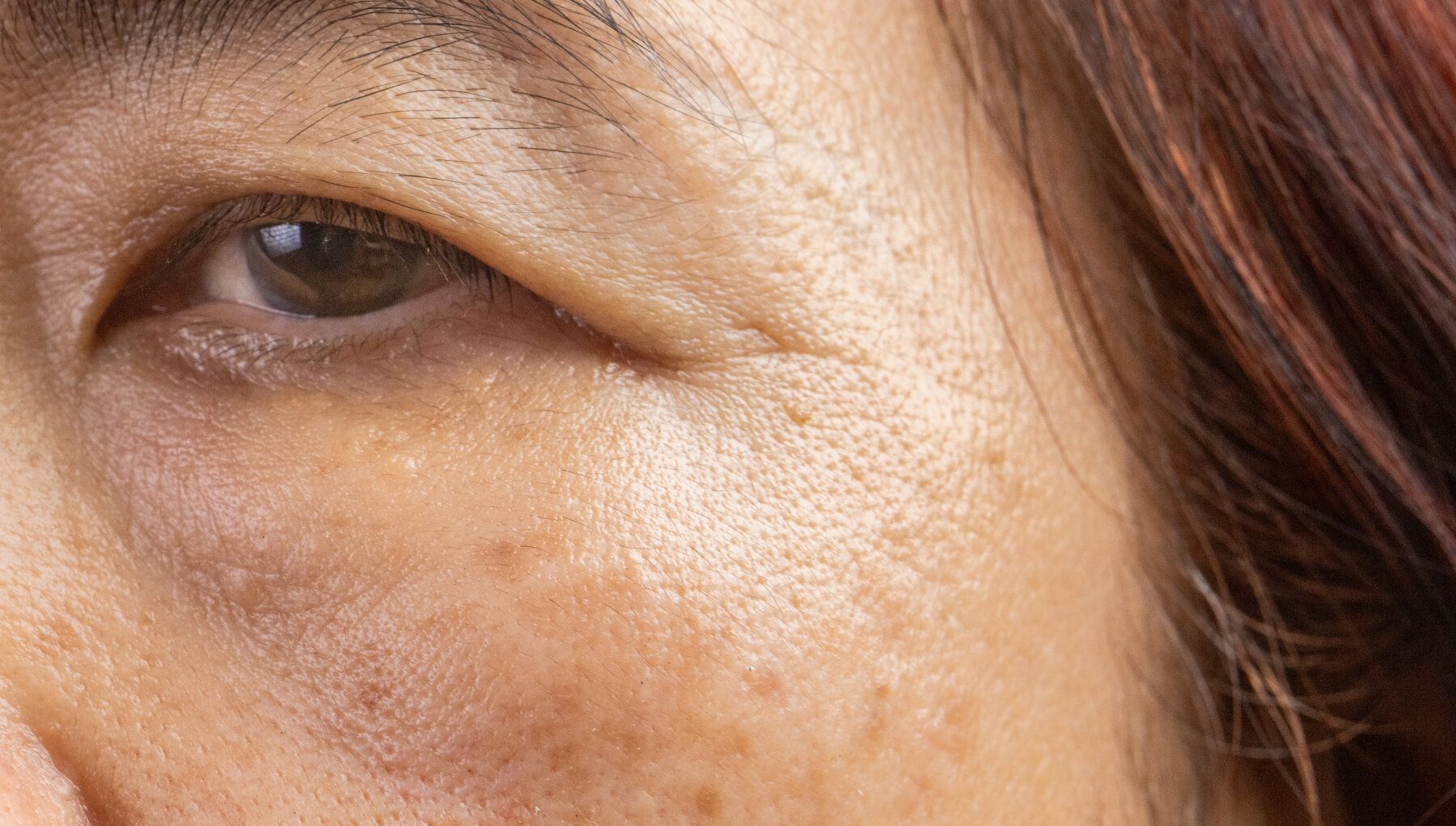 Hooding of the Eye (Ptosis)