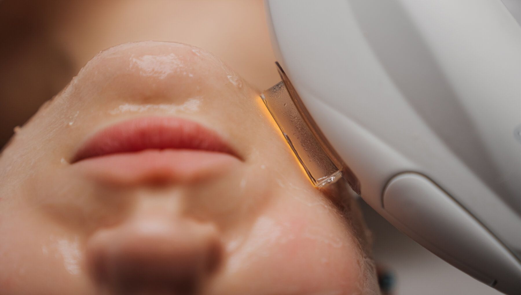 IPL® Photofacial