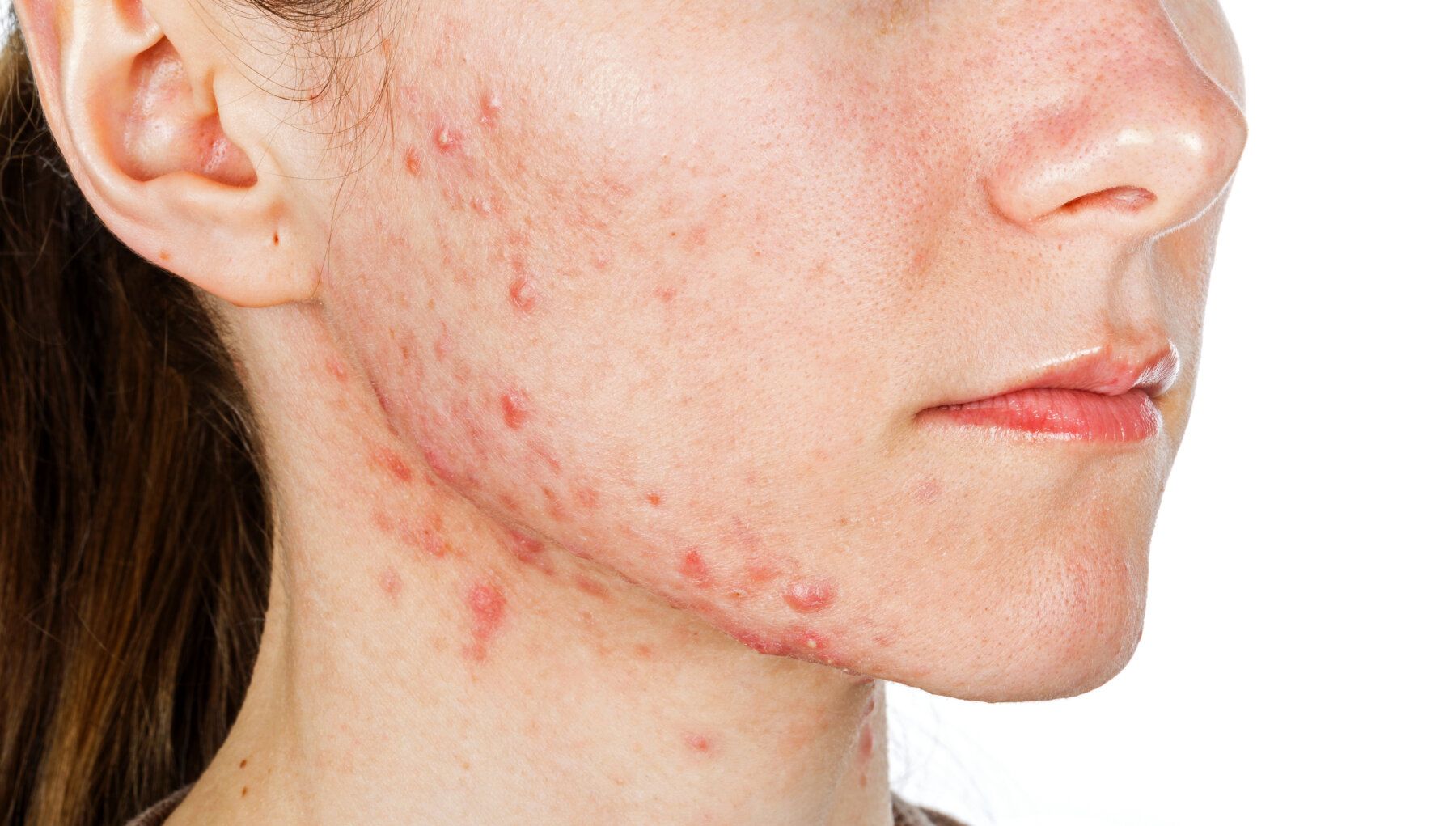 Isotretinoin Acne
