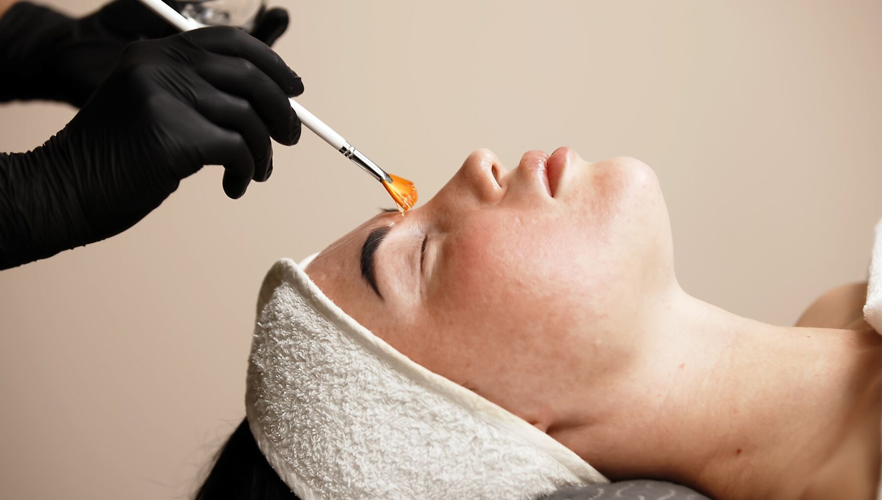 Jessner's Peel