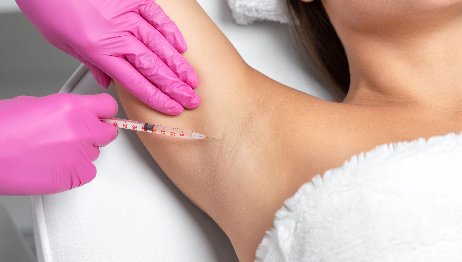 Liposculpture for Hyperhidrosis