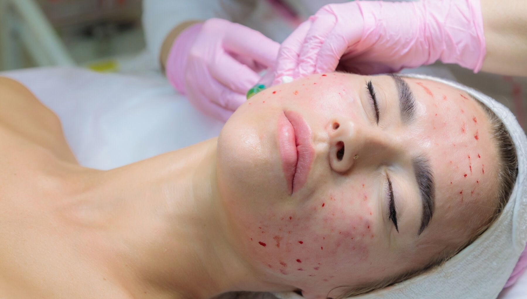 PRP for Skin Rejuvenation