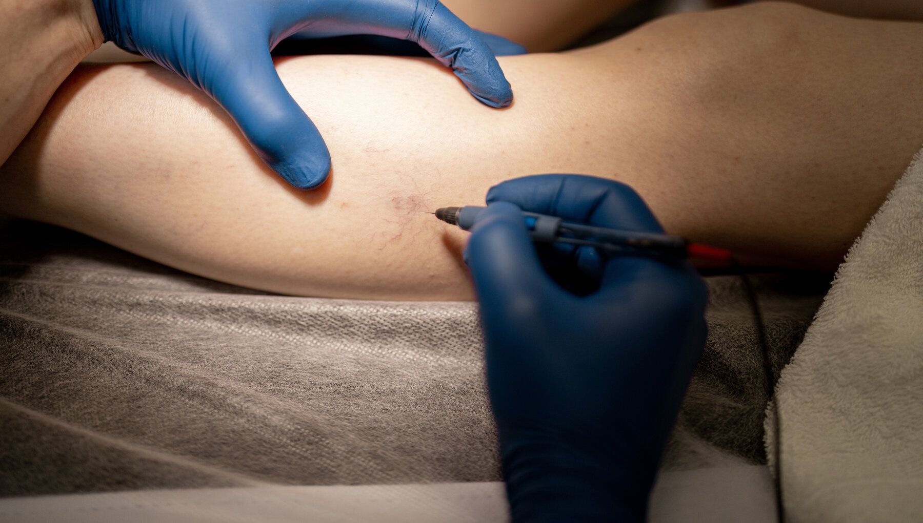 Sclerotherapy
