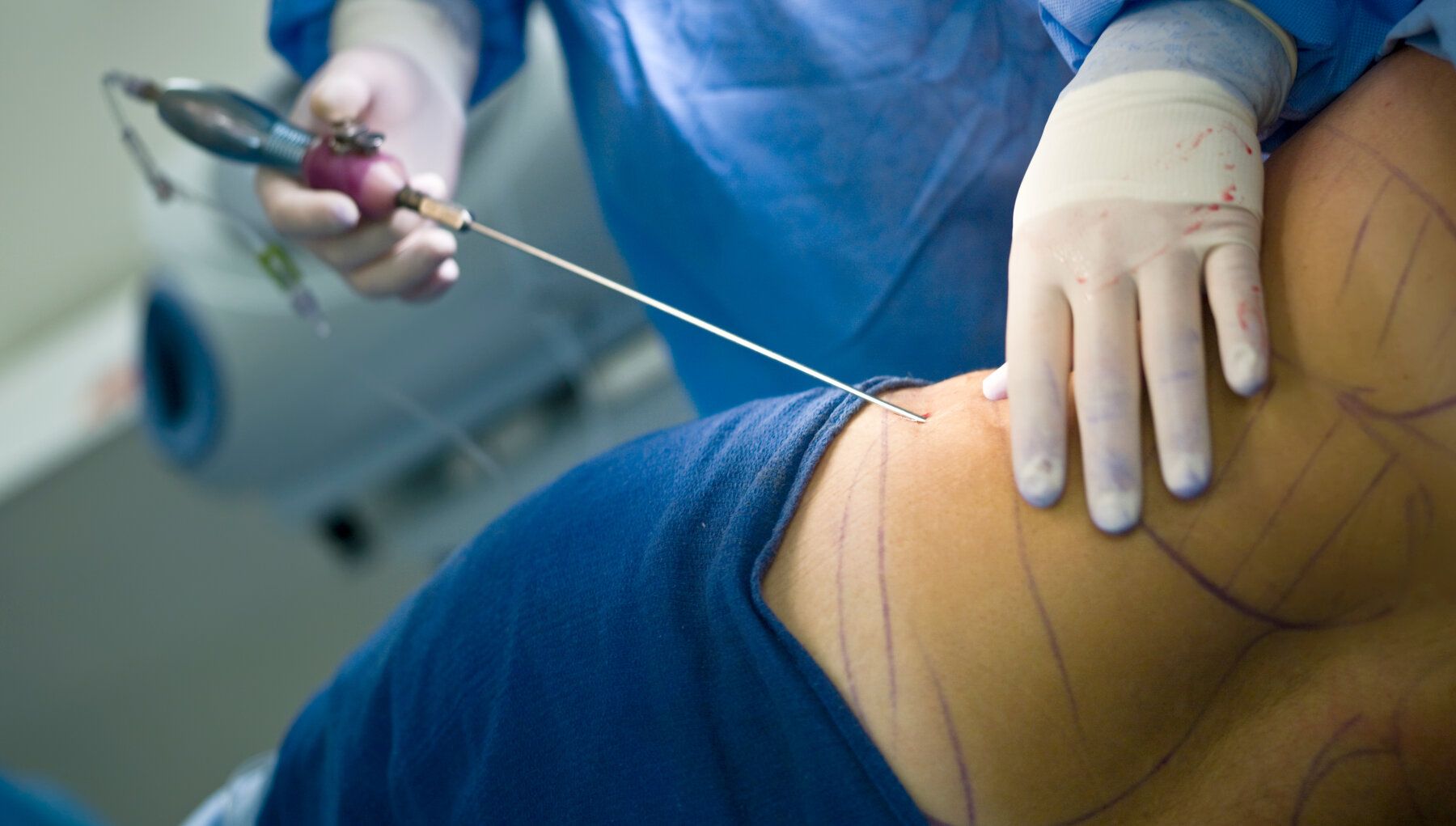 Tumescent Liposuction