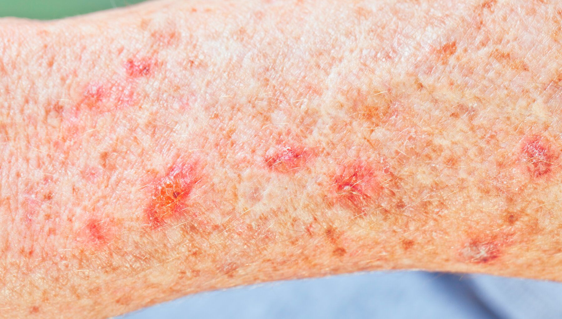 Actinic Keratosis