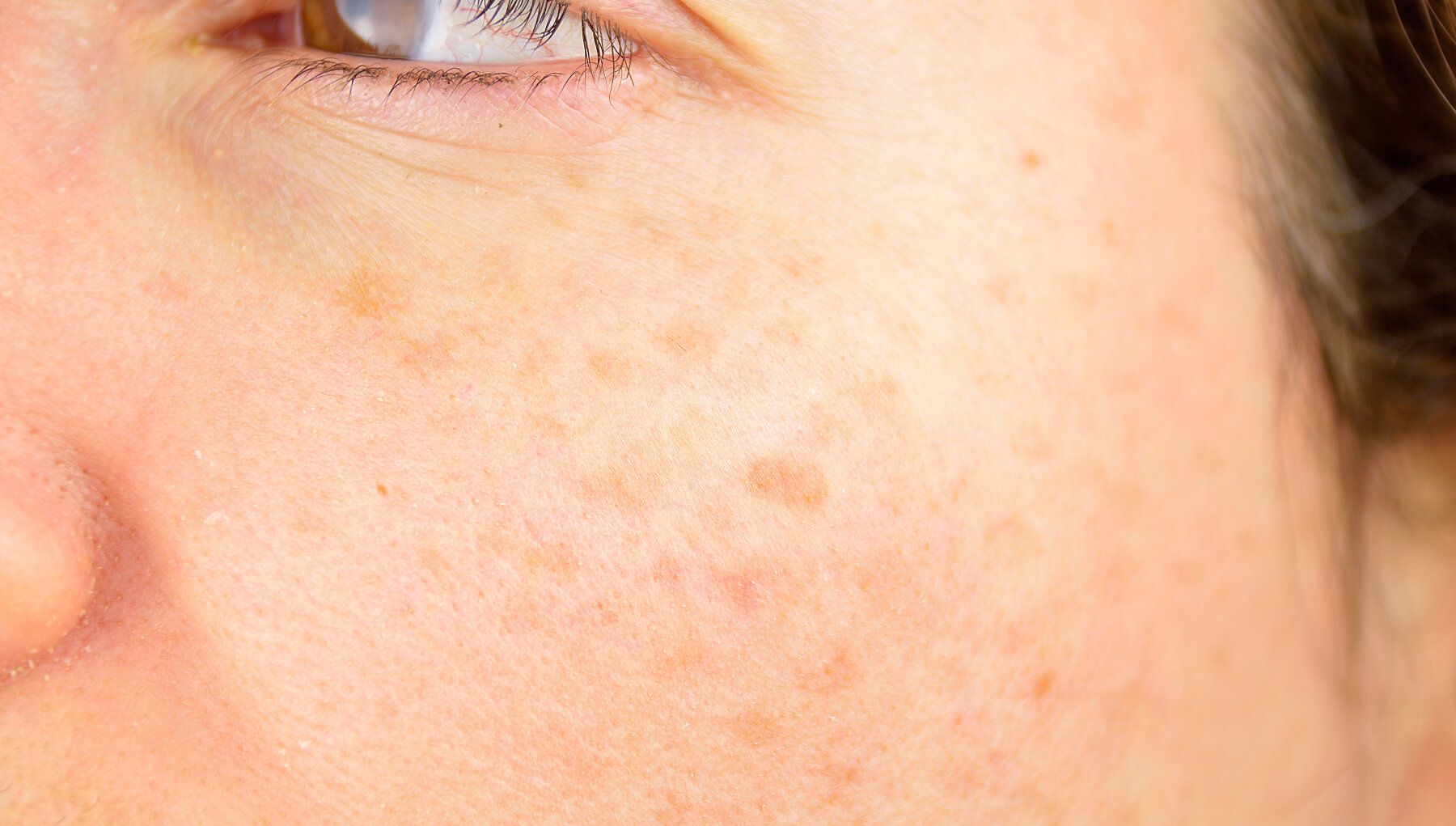 Age Spots